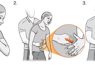 Heimlich Manevrası Nasıl Yapılır?