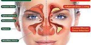 Sinüzit Nedir ve Nasıl Tedavi Edilir?