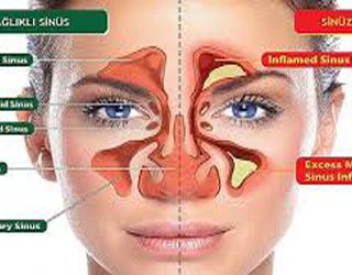 Sinuzit Nedir Ve Nasil Tedavi Edilir