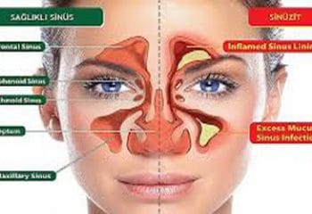 Sinüzit Nedir ve Nasıl Tedavi Edilir?