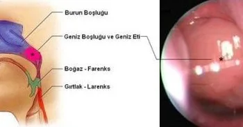 Bebeklerde Geniz Eti