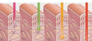 En İyi Lazer Epilasyon Cihazı Hangisidir?