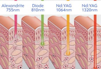 En İyi Lazer Epilasyon Cihazı Hangisidir?