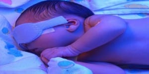 Bebeklerde Bilirubin Yüksekliği