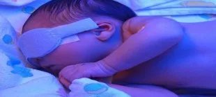 Bebeklerde Bilirubin Yüksekliği