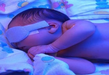 Bebeklerde Bilirubin Yüksekliği