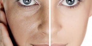 Işık Peeling Nedir ve Nasıl Uygulanır