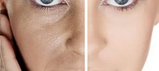 Işık Peeling Nedir ve Nasıl Uygulanır