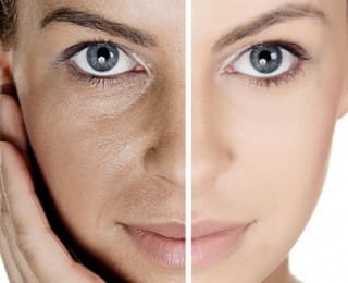 Işık Peeling Nedir ve Nasıl Uygulanır
