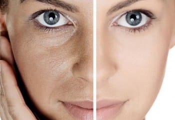 Işık Peeling Nedir ve Nasıl Uygulanır