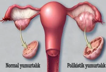 Polikistik Over Sendromu (PCOS) Hastası Olmak