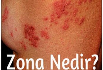 Gece Yanığı (Zona) Hastalığı