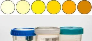 İdrar Rengi ve Anlamları