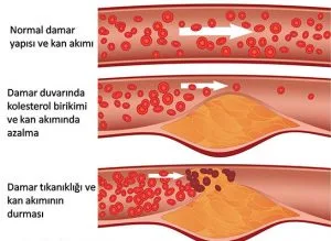 kolesterol-trigliserid-sorunlari
