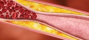 Trigliserid Nedir? Neden Yükselir