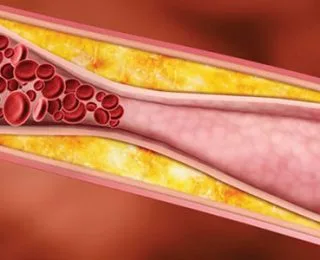 Trigliserid Nedir? Neden Yükselir