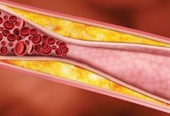 Trigliserid Nedir? Neden Yükselir