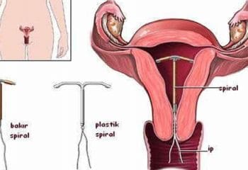 Spiral (Rahim İçi Aracı) Hakkında Bilmeniz Gerekenler