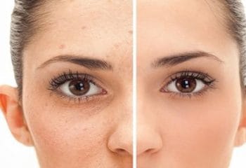 Yara İzlerini Giderecek En İyi Doğal Yöntemler