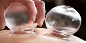 Hacamat Nedir ve Faydaları Nelerdir