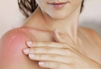 Güneş Yanıklarına İyi Gelen Tedavi Yöntemleri