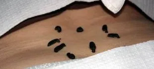 Hirudoterapi Sülük Tedavisi