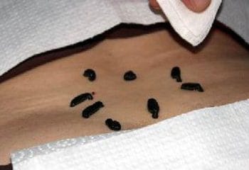 Hirudoterapi Sülük Tedavisi