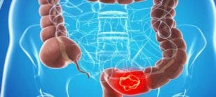 Kanser Olmamak İçin Bağırsağınıza Çok İyi Bakın