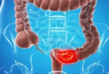 Kanser Olmamak İçin Bağırsağınıza Çok İyi Bakın