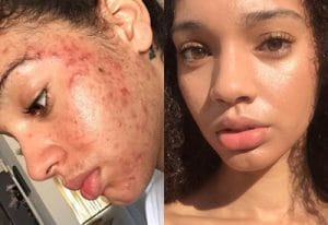 1 Ayda Sivilcelerden Kurtaran Karışım