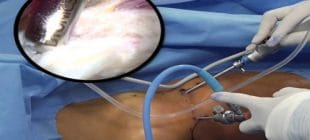 Artroskopi Nedir ve Kullanım Alanları Nelerdir