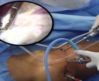 Artroskopi Nedir ve Kullanım Alanları Nelerdir