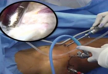 Artroskopi Nedir ve Kullanım Alanları Nelerdir