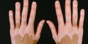Vitiligo Hastalığı Nedir
