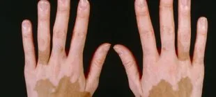 Vitiligo Hastalığı Nedir