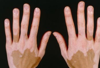 Vitiligo Hastalığı Nedir