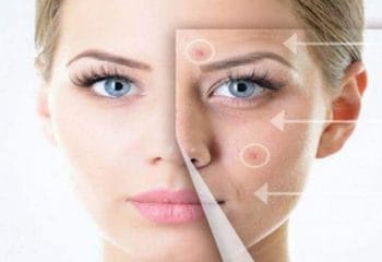 Cilt Kırışıklıklarını Önlemek İçin Hyaluronik Asit’in Önemi