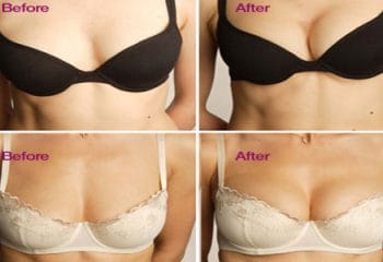 Göğüs Estetiğinde En Çok Sorulanlar ve Cevapları