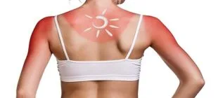 Güneş Yanığına Ne İyi Gelir